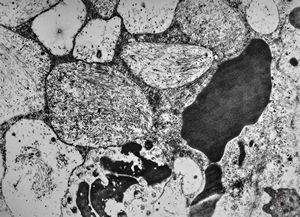 M, 1y. | gangliosidosis - liver M, 1y. | gangliosidosis - liver